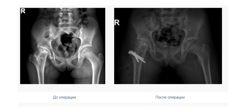 Операция юношеский эпифизеолиз. Юношеский эпифизеолиз тазобедренного сустава.