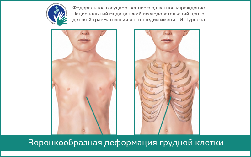 Округлая грудная клетка. Воронкообразная деформация грудной клетки (Pectus Excavatum). Воронкообразная деформация грудной клетки 2 степени. Воронкообразная Грудина у ребенка. Килевидная деформация грудной клетки у детей.