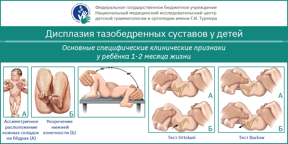 Реферат: Симптомы дисплазии тазобедренных суставов