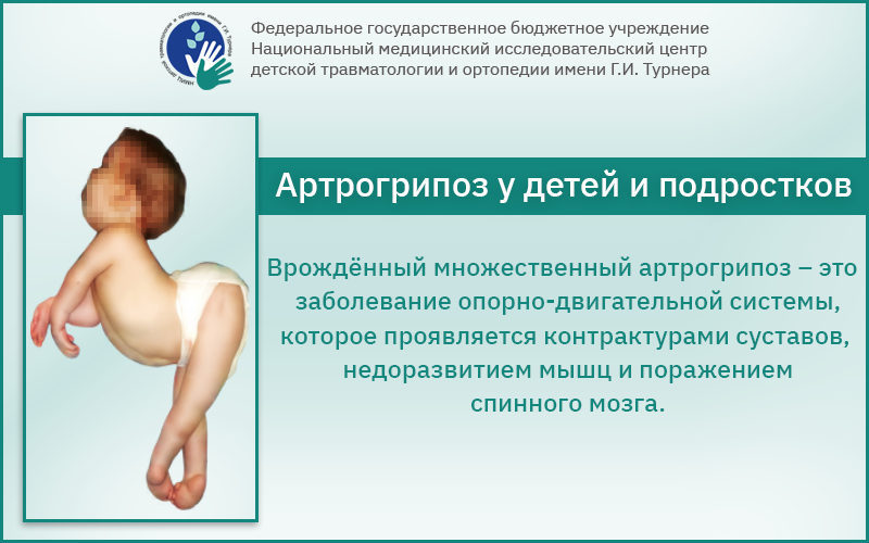 Артрогрипоз у детей и подростков: эффективные методы лечения в РФ