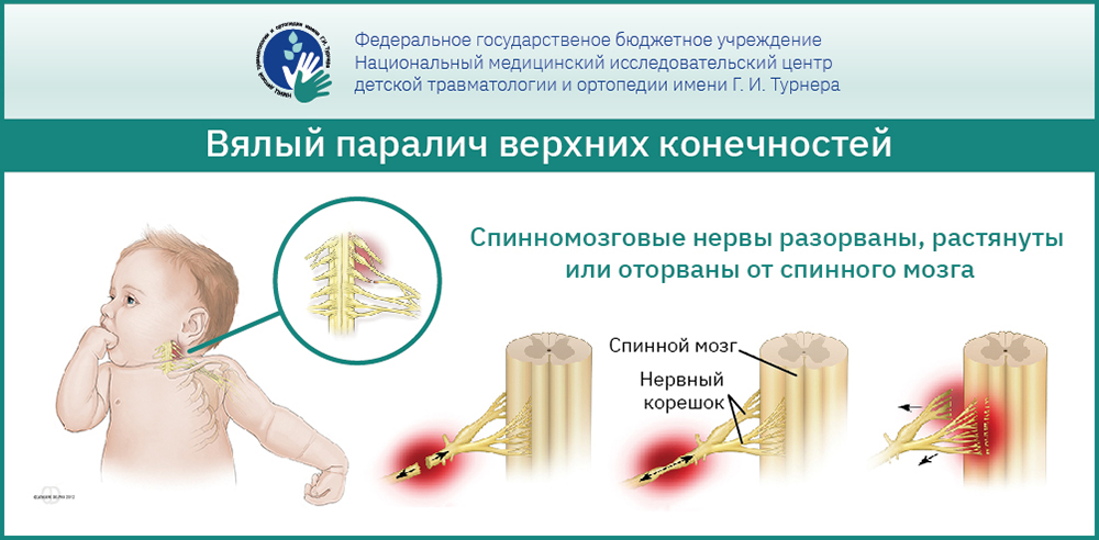 Вялые параличи у детей и подростков — комплексное лечение, инновационные методики