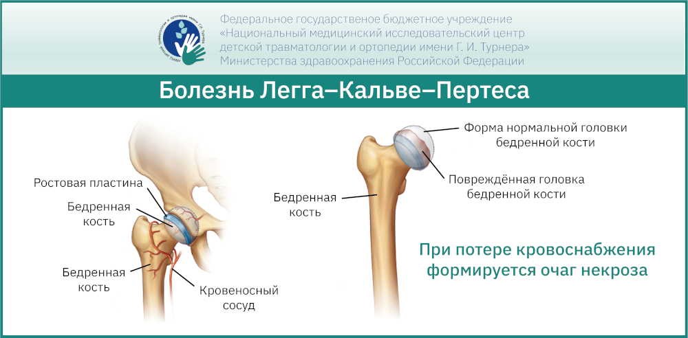 Болезнь Легга-Кальве-Пертеса — диагностика, лечение, причины и стадии развития