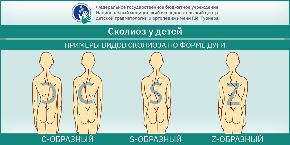 Причины развития сколиоза шейного отдела позвоночника