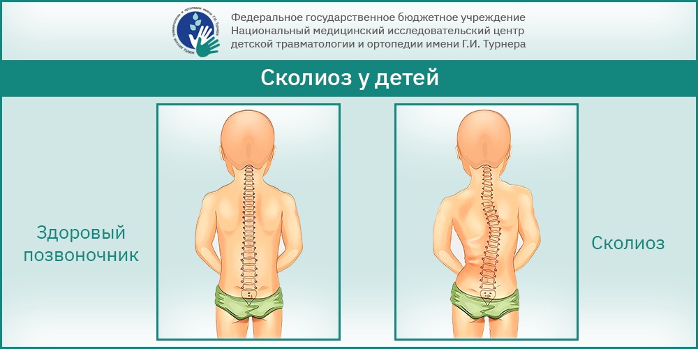 Лечение сколиоза у детей бесплатно в РФ — комплексный подход, передовые технологии