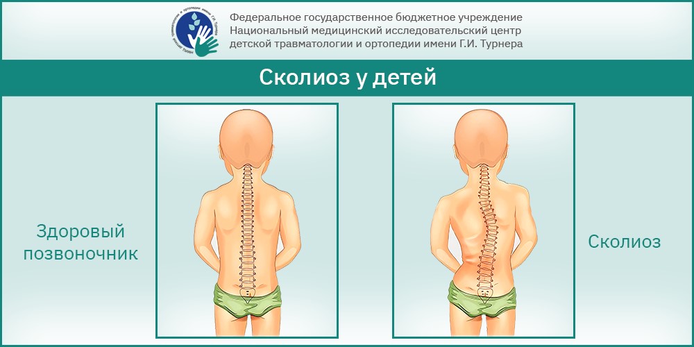 Идиопатический сколиоз — причины, виды, методы диагностики и лечения