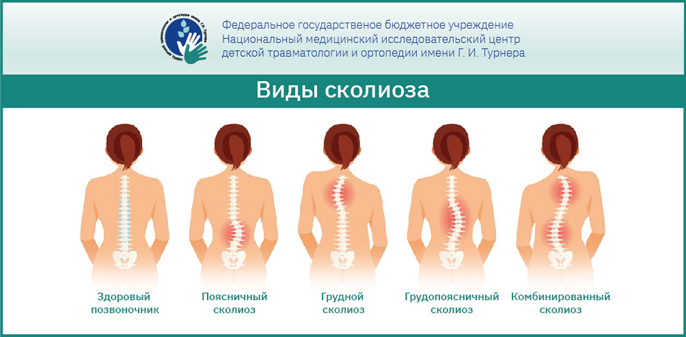 Сколиоз шейного отдела позвоночника симптомы причины методы лечения