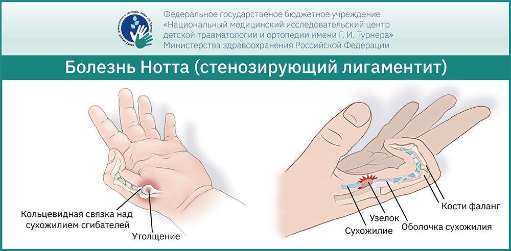 Симптомы вывиха пальца руки