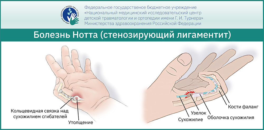 Операция на большом пальце руки