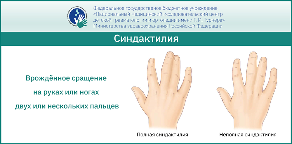 Синдактилия у детей - комплексный подход к лечению