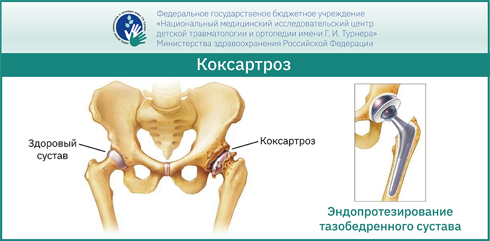 Синовит тазобедренного сустава