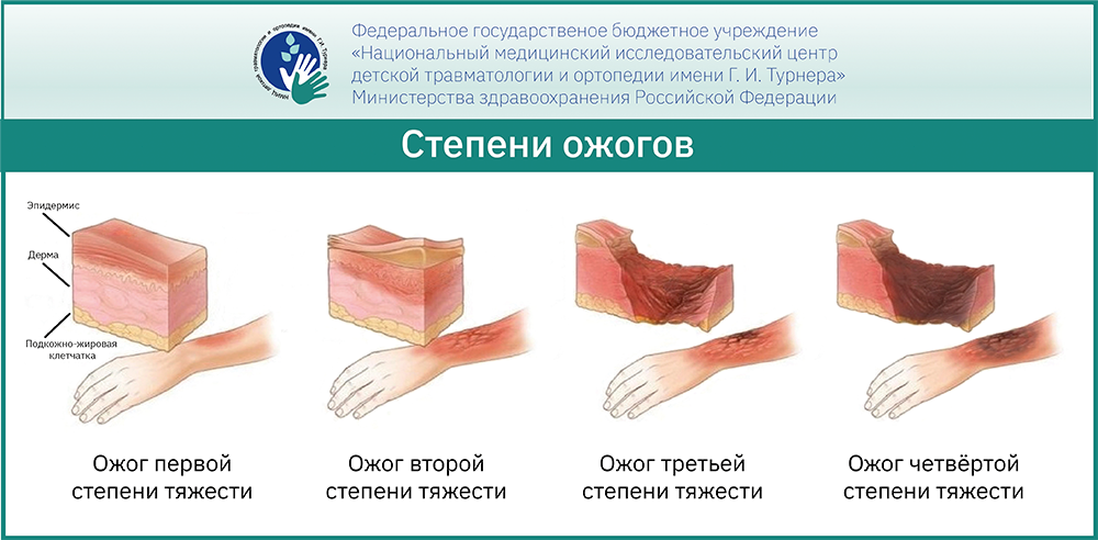 Рубцовые последствия ожогов – уникальные комплексные методики лечения последствий ожогов у детей