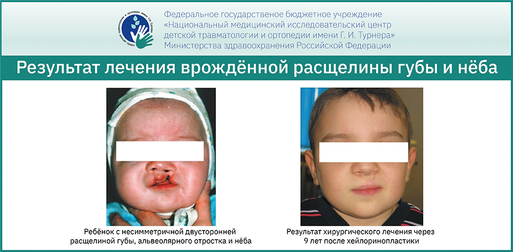 Врождённые расщелины губы и нёба — уникальные результаты лечения