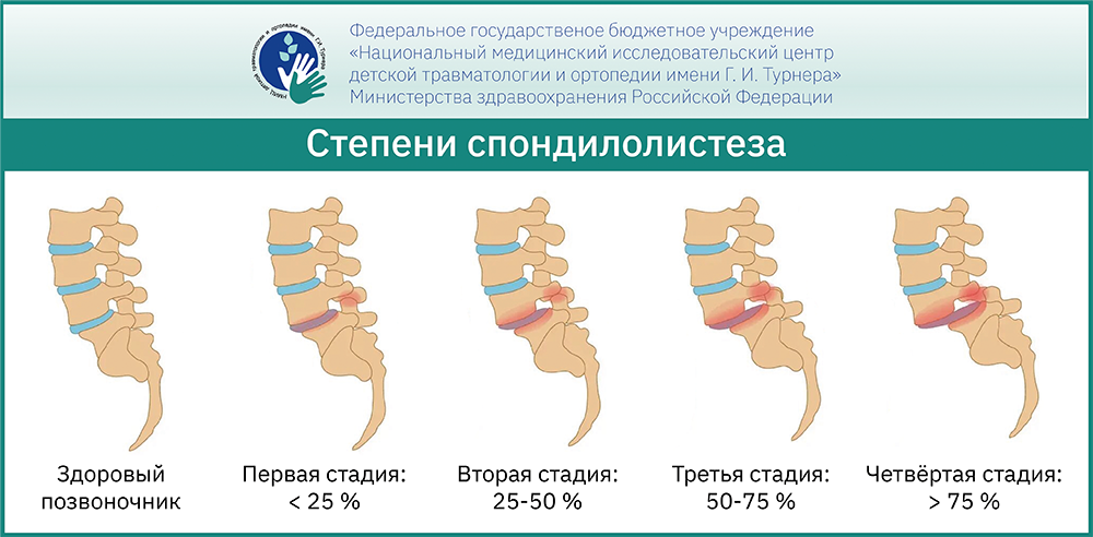 Приобретенные причины спондилолистеза