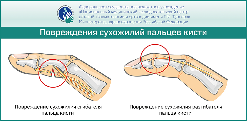 Пластика сухожилий - MedClinic