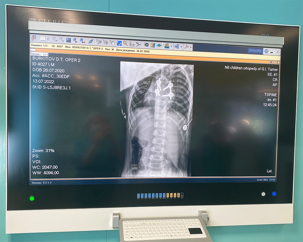 В ФГБУ «НМИЦ детской травматологии и ортопедии им. Г. И. Турнера» Минздрава России провели операцию двухлетнему мальчику с применением отечественной металлоконструкции