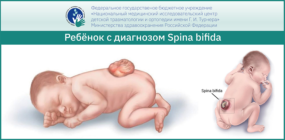 Лечение Spina bifida в России – эффективные методы лечения в НМИЦ им. Г. И. Турнера