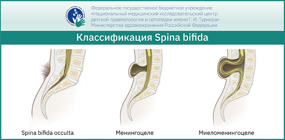 Spina bifida у детей – лечение патологии и особенности заболевания