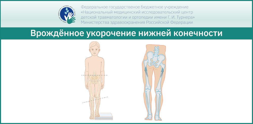 Врождённое укорочение нижней конечности у ребёнка