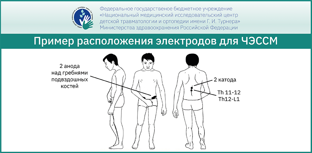 Методика неинвазивной чрескожной электрической стимуляции спинного мозга