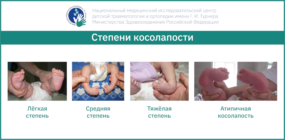 Врождённая косолапость у детей – самый эффективный метод лечения