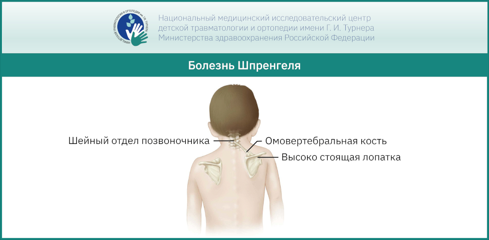 Болезнь Шпренгеля: уникальные методики лечения в НМИЦ имени Г. И. Турнера Минздрава России