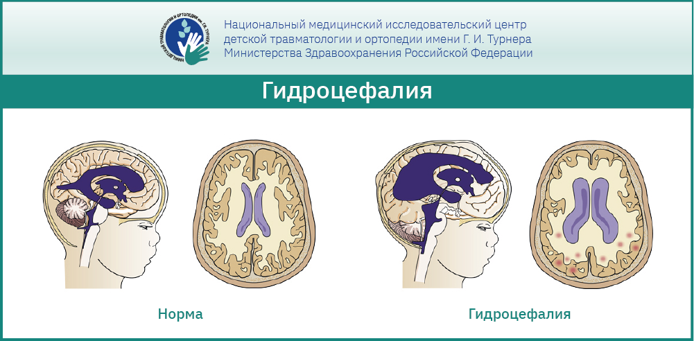 Гидроцефалия и другие неврологические осложнения у детей со Spina bifida