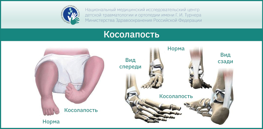 Лечение деформации стопы у детей в НМИЦ им. Г. И. Турнера