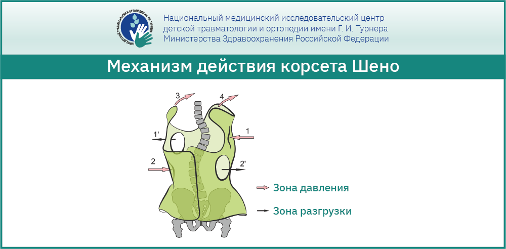 Корсет Шено - ортезирование при идиопатическом сколиозе