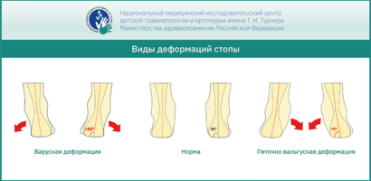 виды патологии стопы