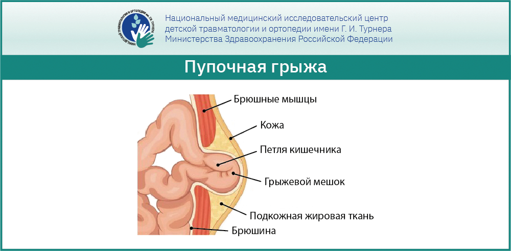 Пупочная грыжа у детей: рекомендации врачей и современные методы лечения