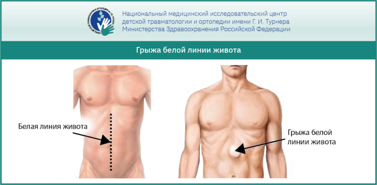 Грыжа белой линии живота у ребенка: основные аспекты, рекомендации врачей и мето