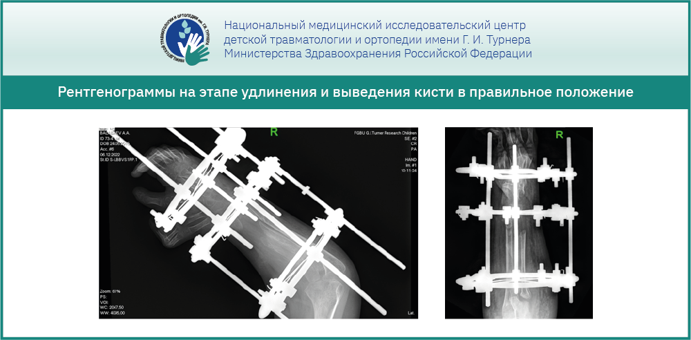 Реконструктивная операция у ребёнка с редкой врождённой аномалией – «зеркальной кистью»