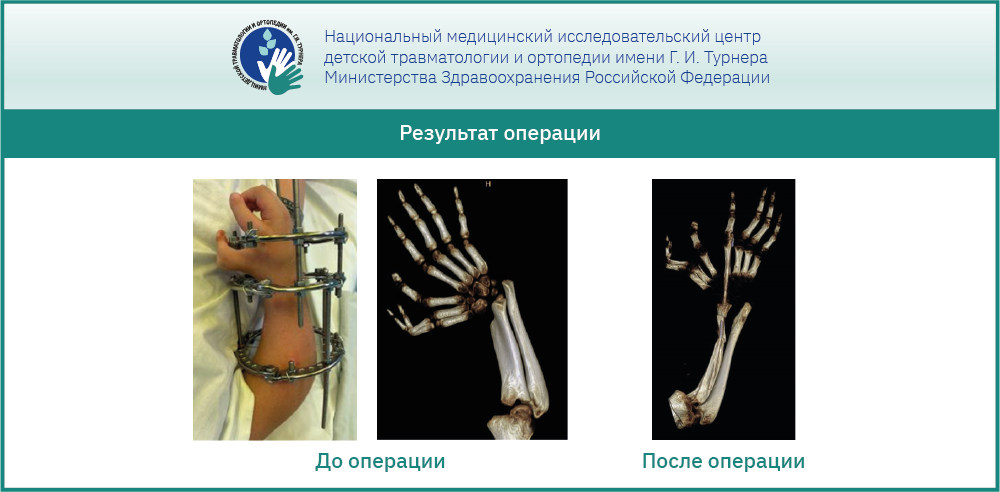 Реконструктивная операция у ребёнка с редкой врождённой аномалией – «зеркальной кистью»