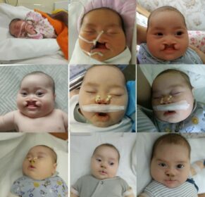 «Наш волшебный, удивительный, необыкновенный малыш» – история лечения малыша с полной двусторонней расщелиной губы и нёба