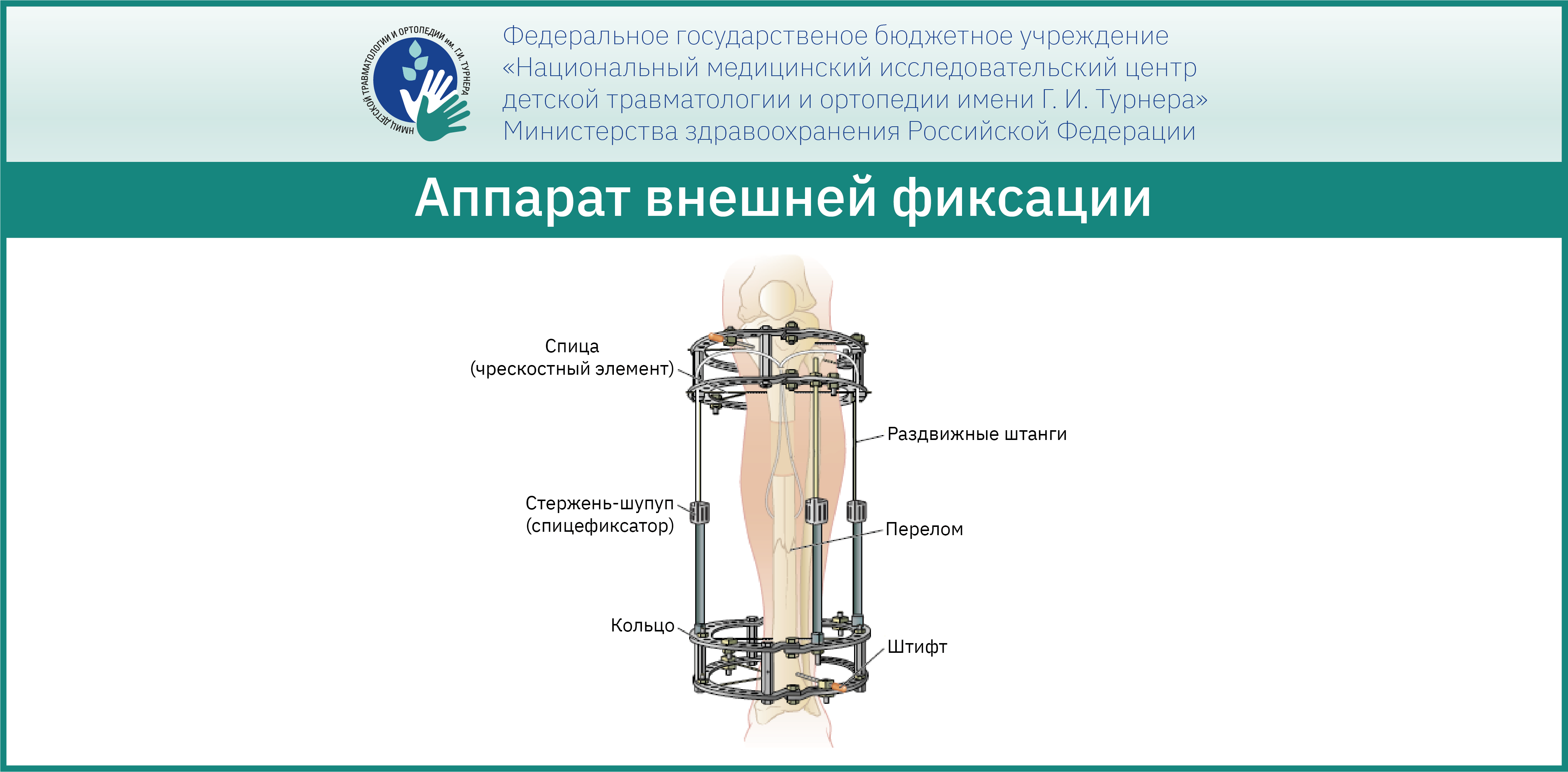 Аппарат Илизарова на ноге человека