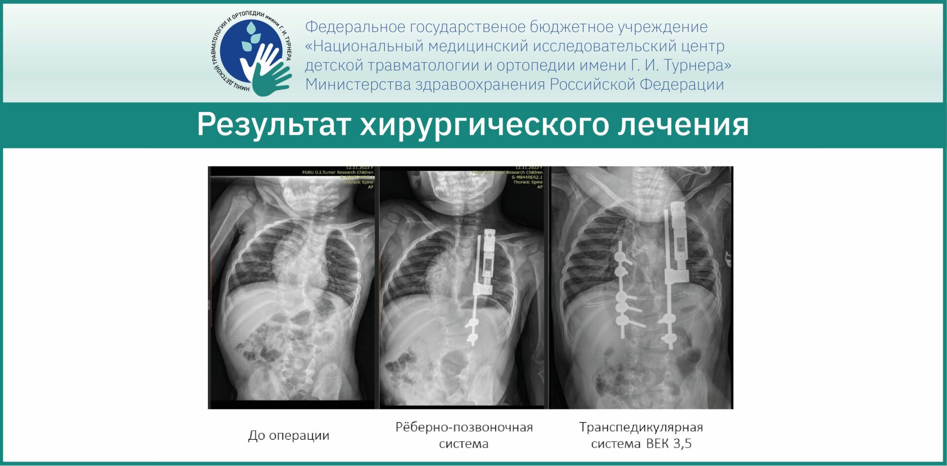 Маленькая героиня из Приморского края: двухлетняя девочка с врождёнными аномалиями позвоночника проходит успешное лечение в НМИЦ имени Г. И. Турнера