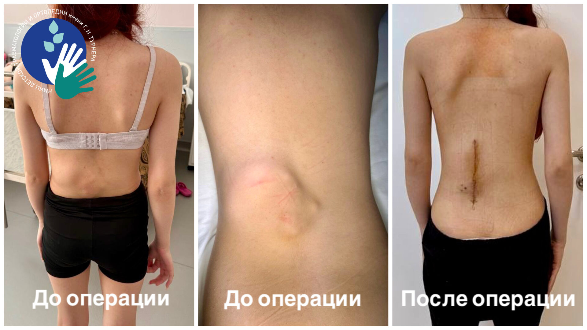 В НМИЦ имени Г. И. Турнера провели успешную операцию по удалению гигантского экзостоза позвоночника