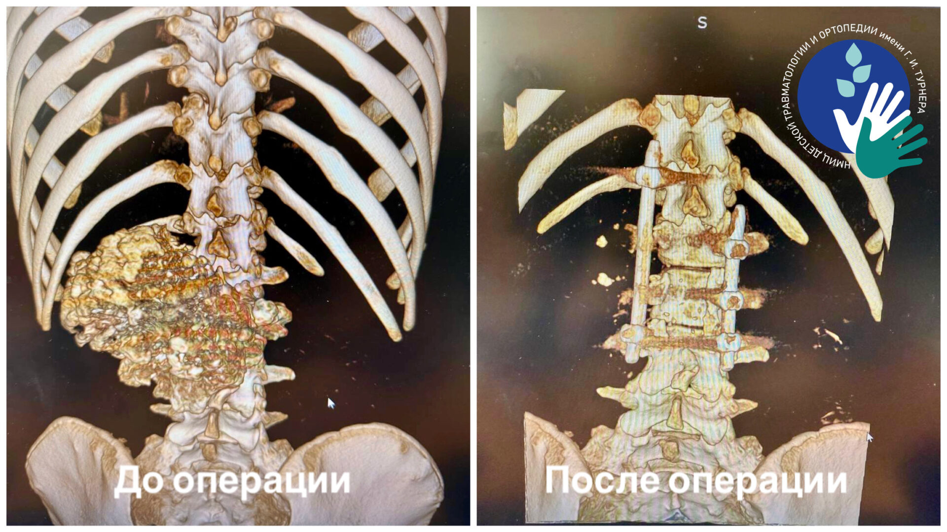 В НМИЦ имени Г. И. Турнера провели успешную операцию по удалению гигантского экзостоза позвоночника