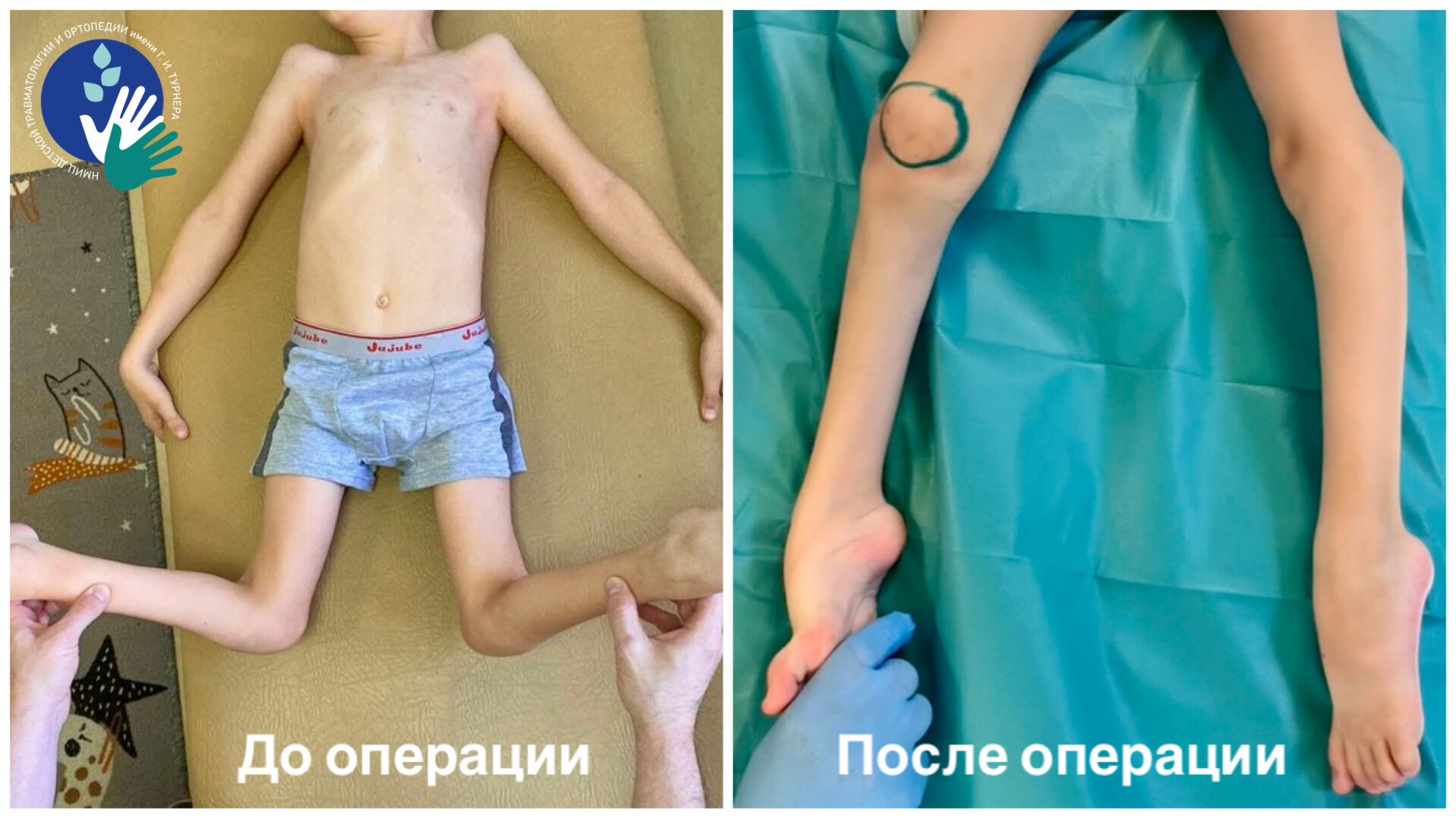 Врачи НМИЦ имени Г. И. Турнера успешно провели первый этап коррекции тяжёлой деформации ног у ребёнка с ДЦП
