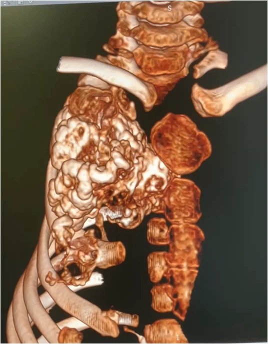 В НМИЦ имени Г. И. Турнера успешно удалён гигантский экзостоз у пятилетнего мальчика